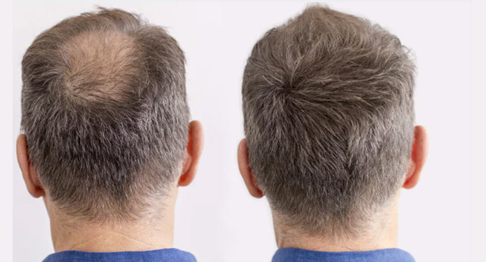 Before and after applying Nut JOb to balding crown