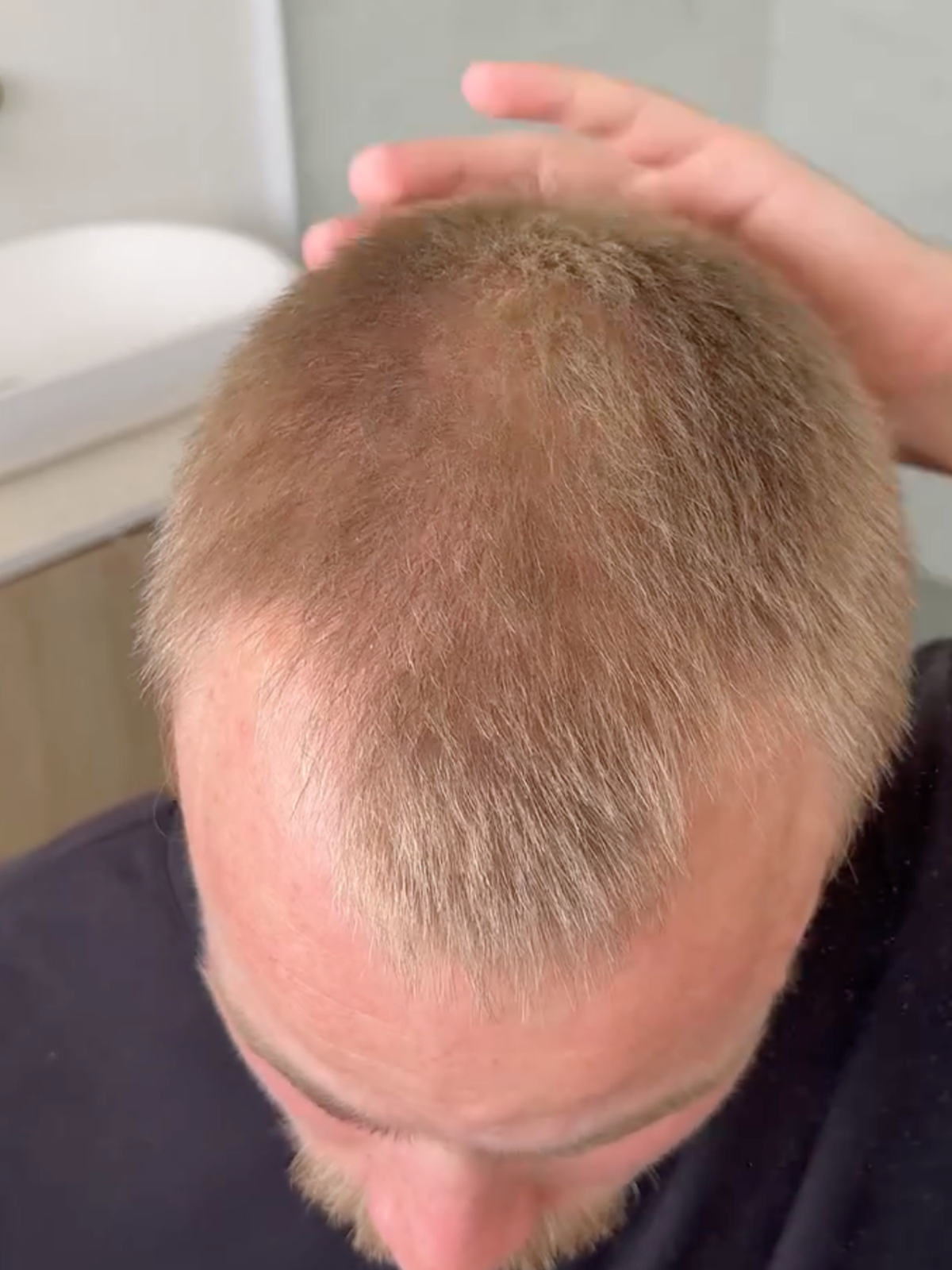 Man's thinning crown seen from above, before applying Nut Job hair fibres