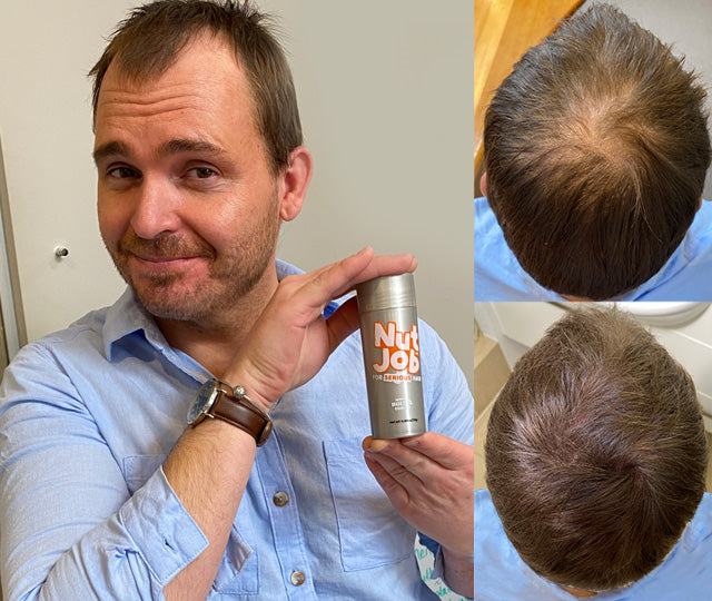 Man holding a Nut Job bottle beside two top-down photos of his crown, one thinning and one fuller-looking